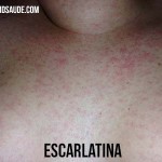 ESCARLATINA – Sintomas e Tratamento